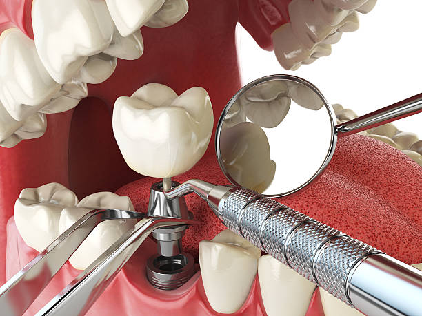 Best Emergency Denture Repair in West Laurel, MD